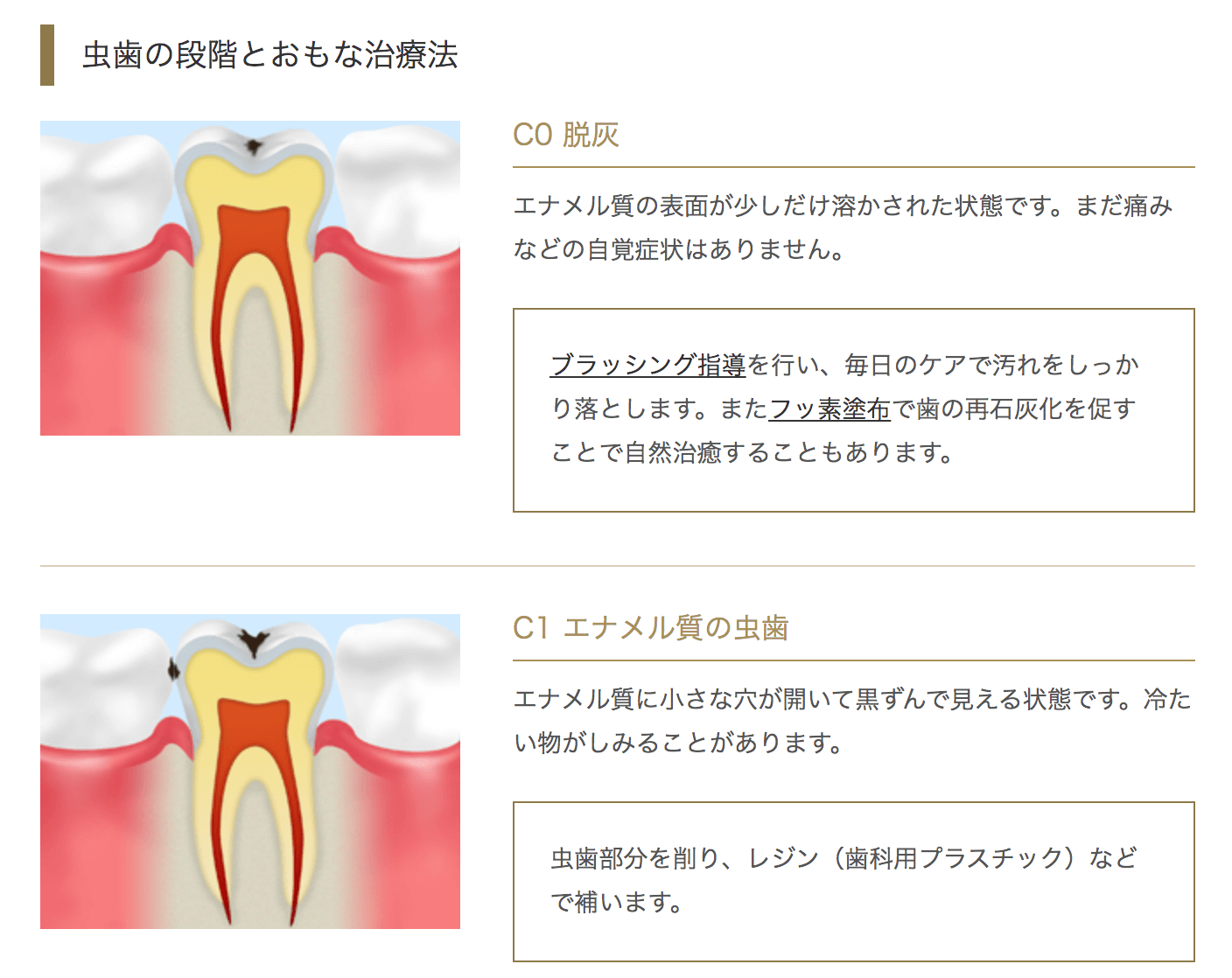 虫歯の進行段階(痛みを感じる前)
